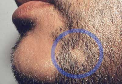 Chiazze nella barba: alopecia?